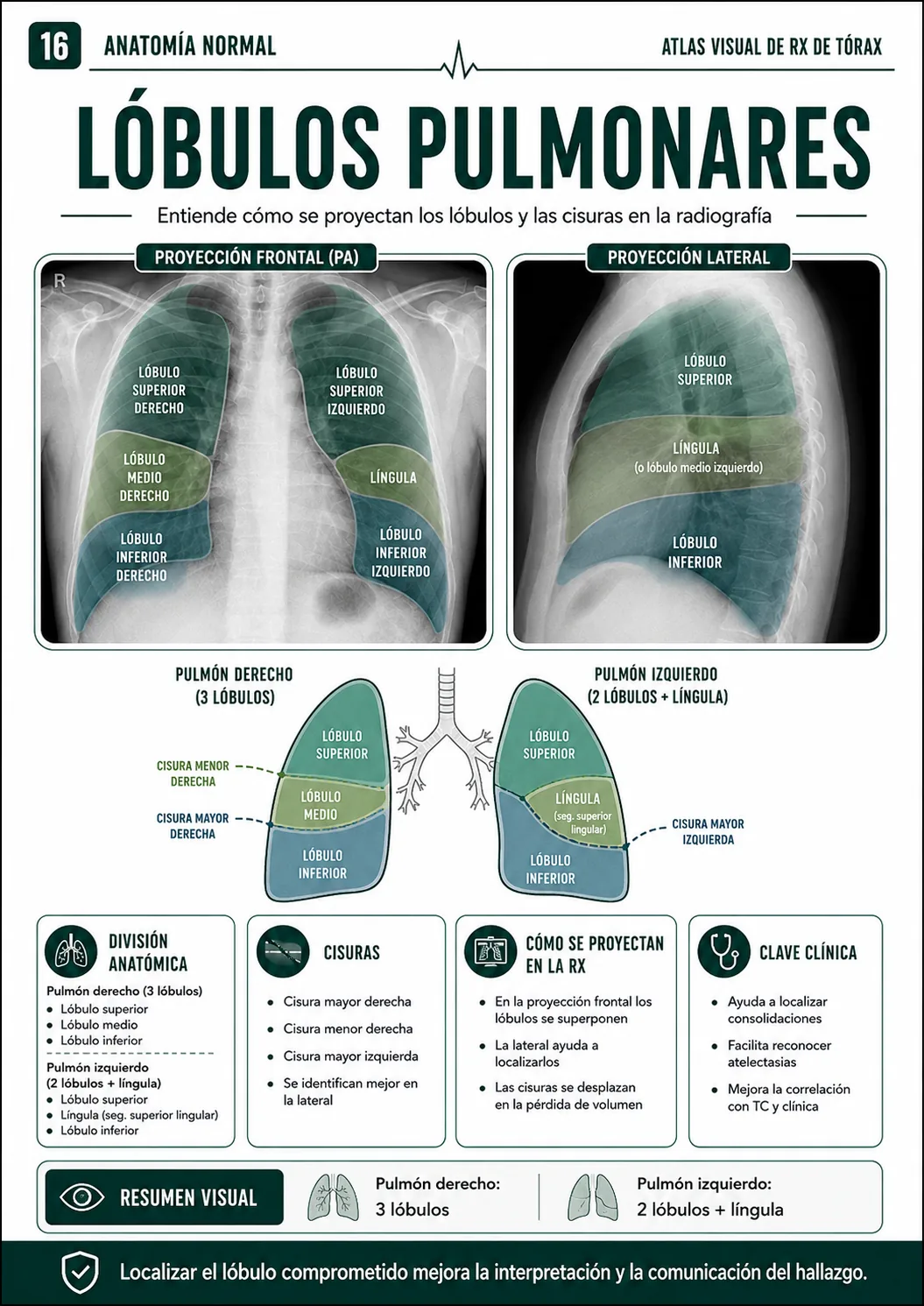 Lóbulos pulmonares