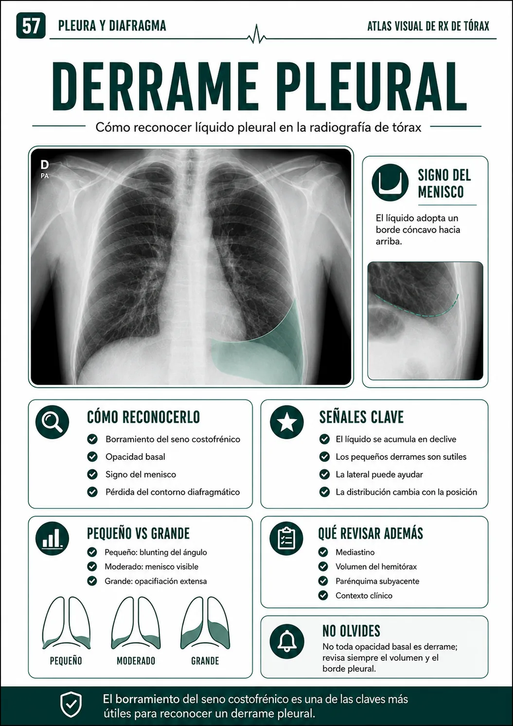 Derrame pleural
